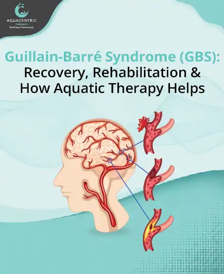Guillain-Barré Syndrome (GBS): Recovery, Rehabilitation & How Aquatic Therapy Helps