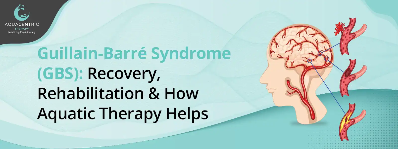 Guillain-Barré Syndrome (GBS): Recovery, Rehabilitation & How Aquatic Therapy Helps 1 GBS recovery through aquatic therapy and rehabilitation exercises