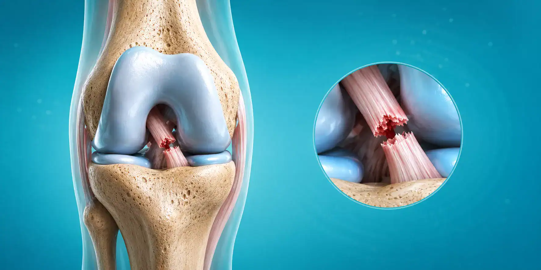 ACL Tear