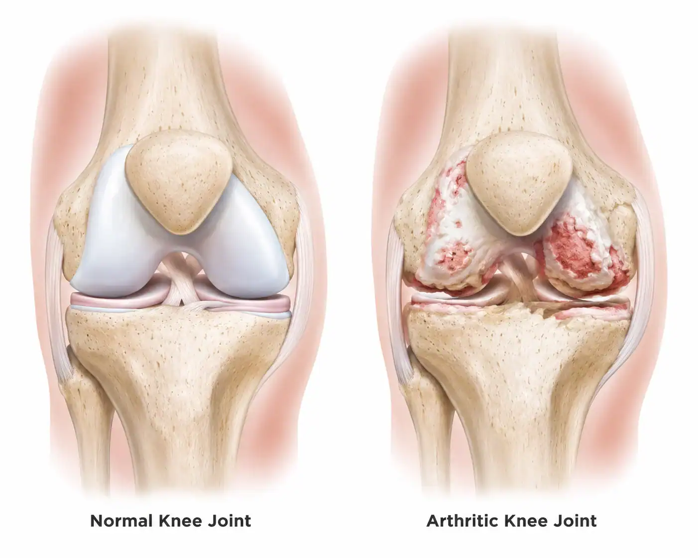 Arthritis