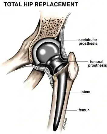 Aquatic vs Land Therapy After Total Hip Replacement | Which Wins? 2 Total hip replacement rehabilitation