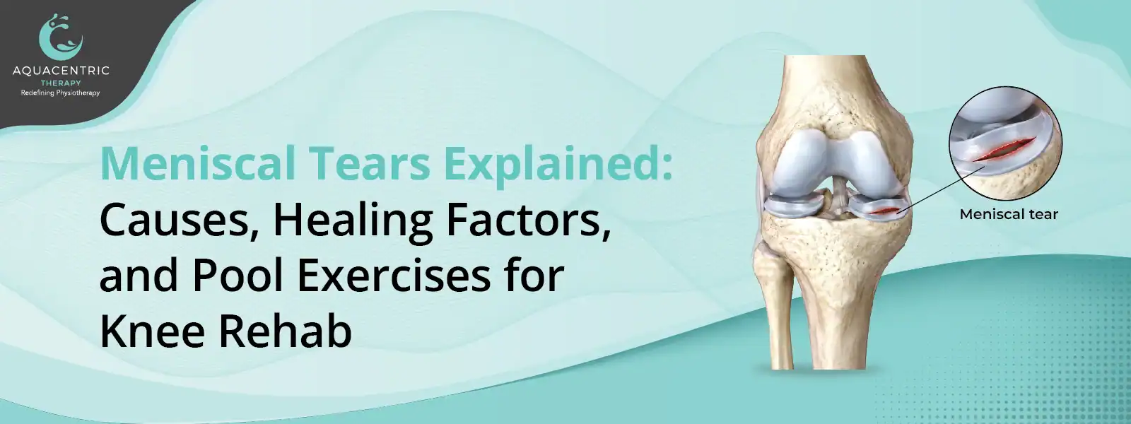 Pool exercises for meniscal tear knee rehabilitation 